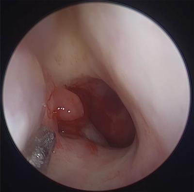 A combined microinvasive trans-submandibular and nasendoscopy surgical approach to dissect recurrent or radiotherapy-insensitive nasopharyngeal carcinoma